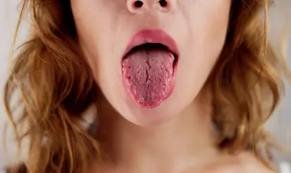 Ağız Kuruluğu neden olur | Piano Dental Clinic | Estetik Diş Hekimliği | Dental İmplantlar Ağız kuruluğu neden olur - tükürük bezlerinin çalışmaması sonucu oluşan durum