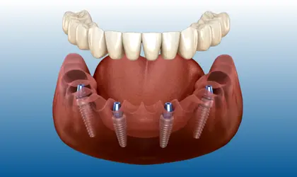 All-on-four | Piano Dental Clinic | Estetik Diş Hekimliği | Dental İmplantlar All on four implant