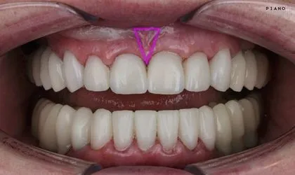 Frenilektomi | Piano Dental Clinic | Estetik Diş Hekimliği | Dental İmplantlar Frenilum dokuların aşırı gelişmiş, kısa, kalın veya sıkı olması, ağız ve diş sağlığı üzerinde olumsuz etkiler yaratabilir. Frenilektomi, bu sorunları çözmek için etkili ve konforlu bir cerrahi yöntemdir.