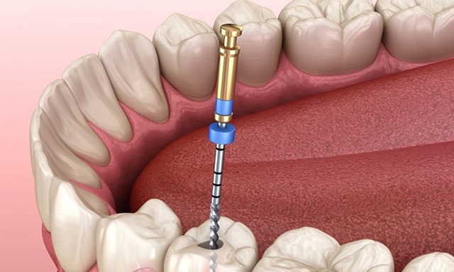 Kanal Tedavisi | Piano Dental Clinic | Estetik Diş Hekimliği | Dental İmplantlar Kanal tedavisi yapılan dişin iç kısmında yer alan enfekte, iltihaplı veya çürümüş dokuları temizlenmesi