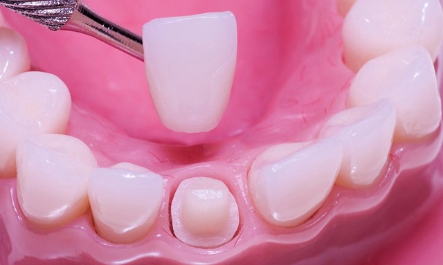 Zirkonyum Kuron | Piano Dental Clinic | Estetik Diş Hekimliği | Dental İmplantlar Tam Seramik Kuron